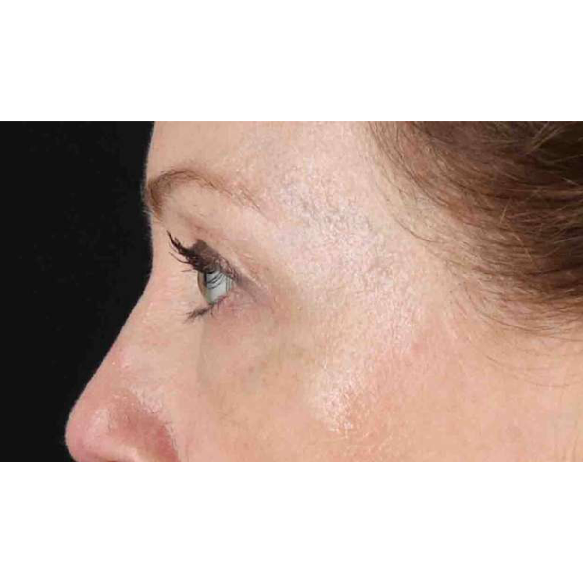 Eyelid Surgery Before & After Patient #1968