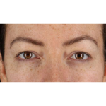 Eyelid Surgery Before & After Patient #1979