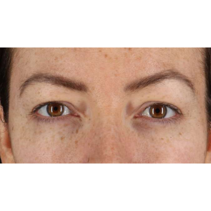 Eyelid Surgery Before & After Patient #1979