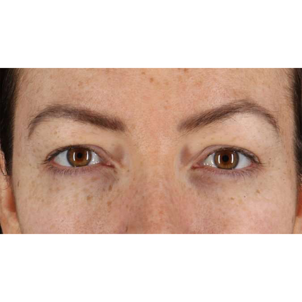 Eyelid Surgery Before & After Patient #1979