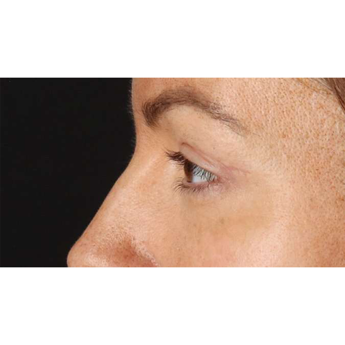 Eyelid Surgery Before & After Patient #1979