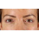 Eyelid Surgery Before & After Patient #1979