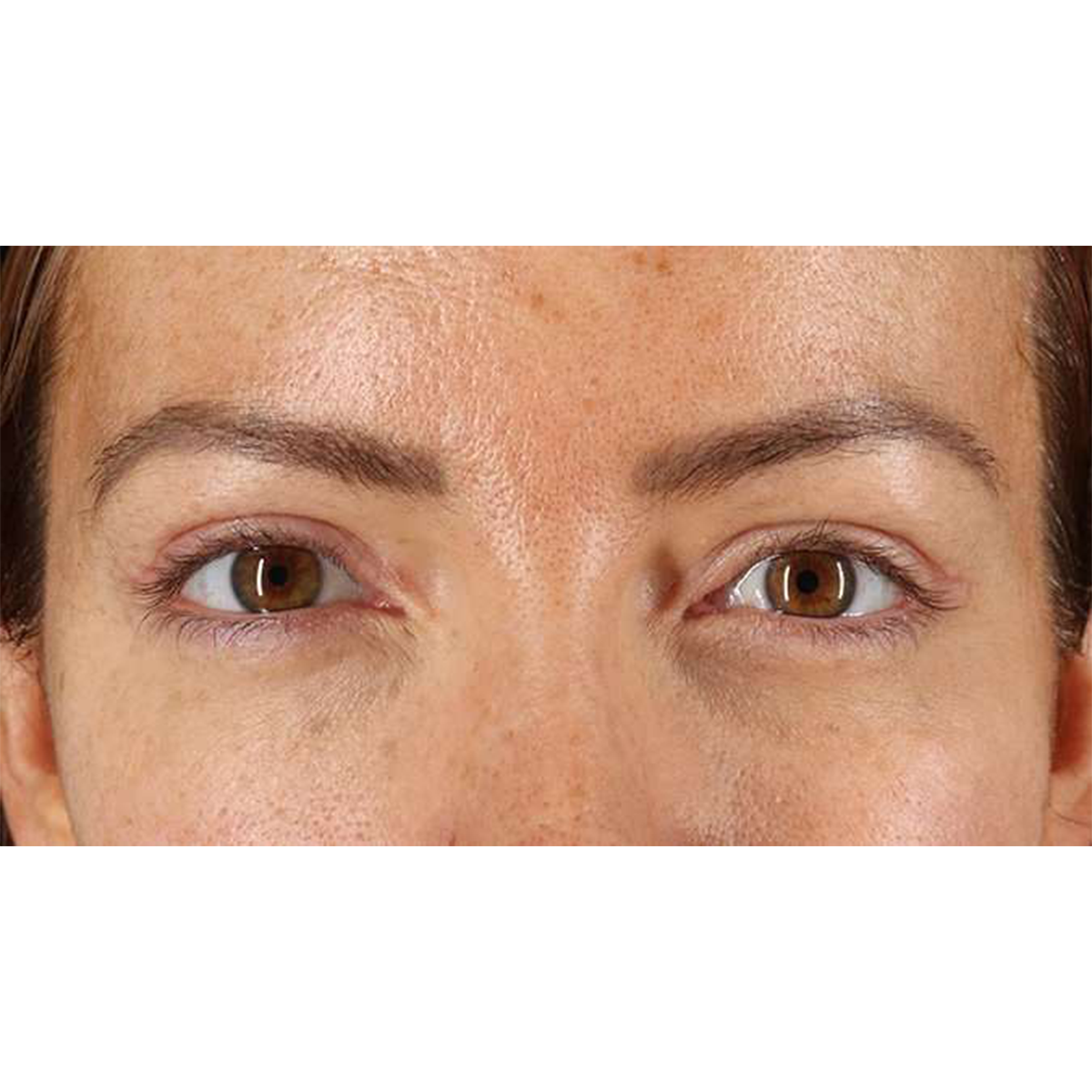 Eyelid Surgery Before & After Patient #1979
