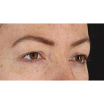 Eyelid Surgery Before & After Patient #1979