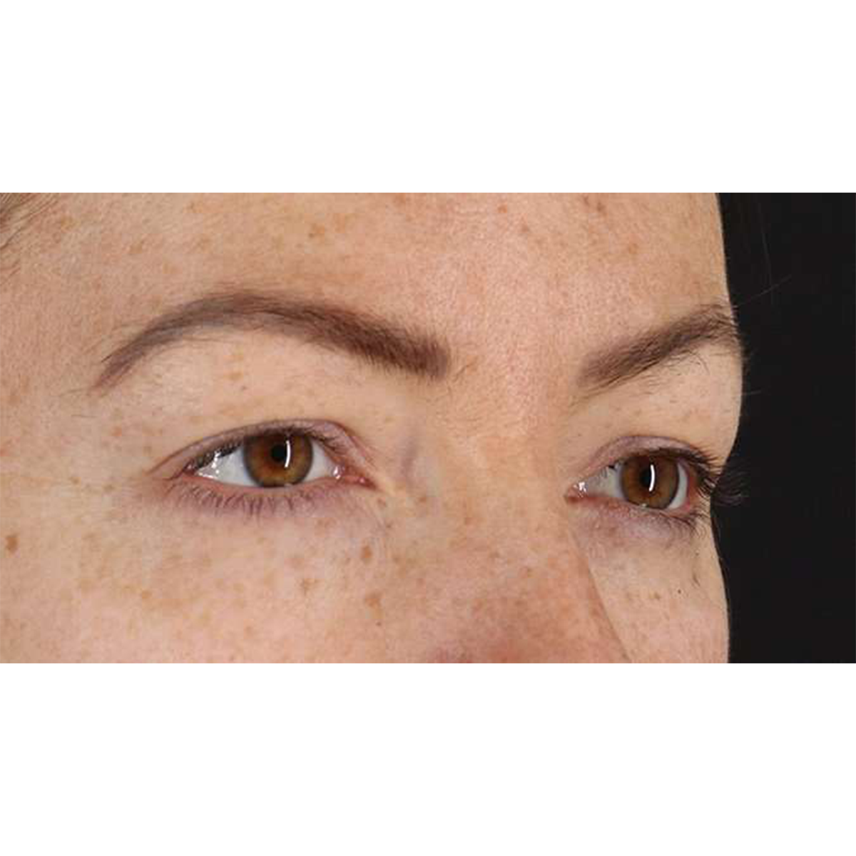 Eyelid Surgery Before & After Patient #1979