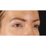 Eyelid Surgery Before & After Patient #1979