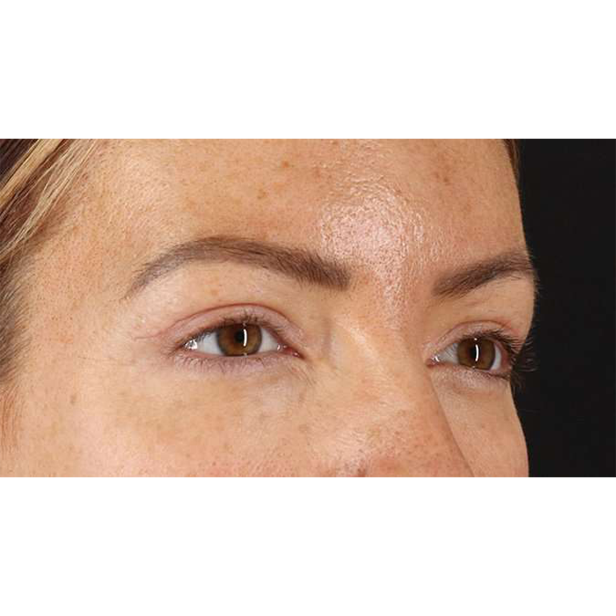 Eyelid Surgery Before & After Patient #1979