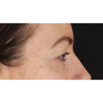 Eyelid Surgery Before & After Patient #1979