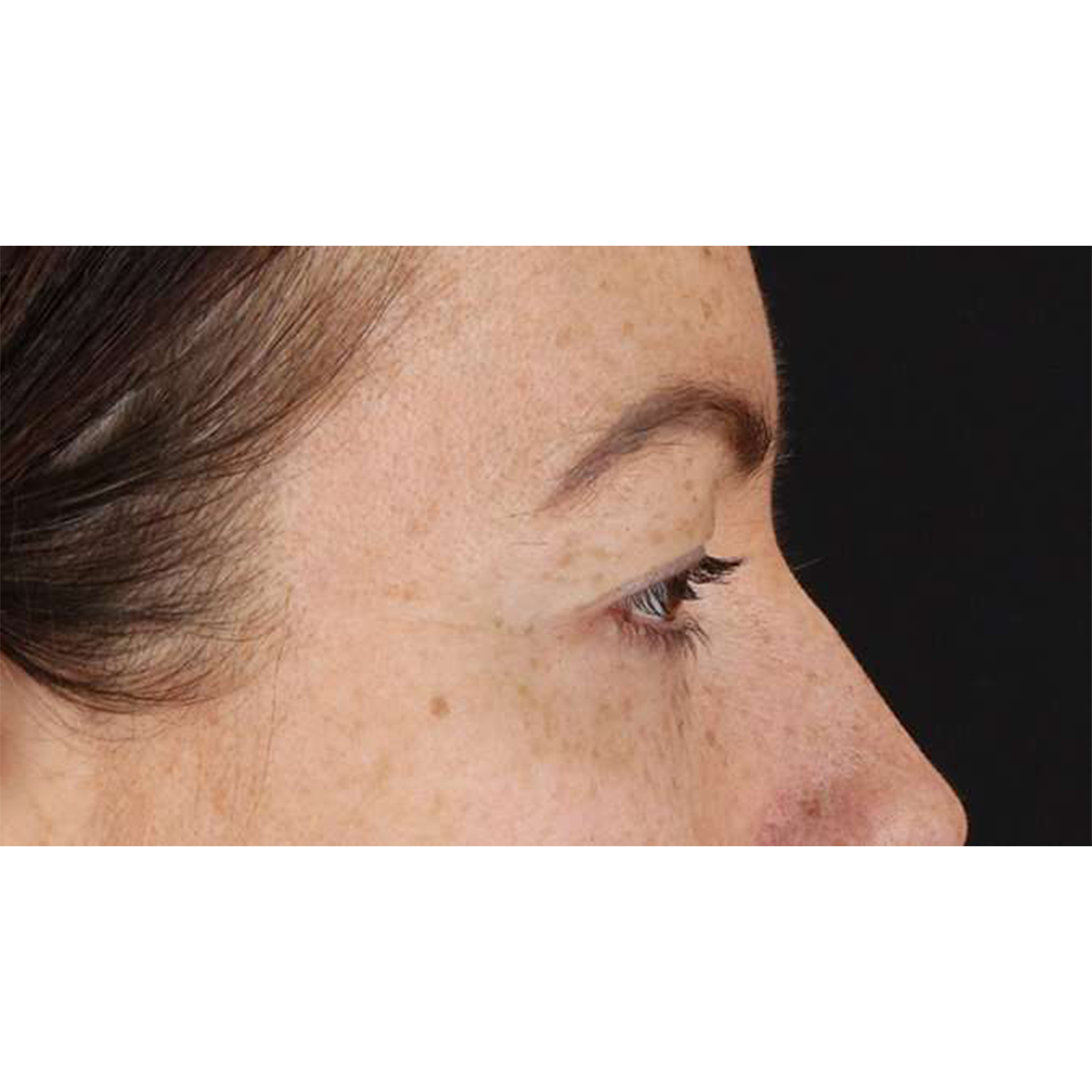 Eyelid Surgery Before & After Patient #1979