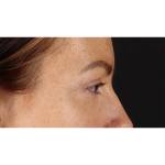Eyelid Surgery Before & After Patient #1979