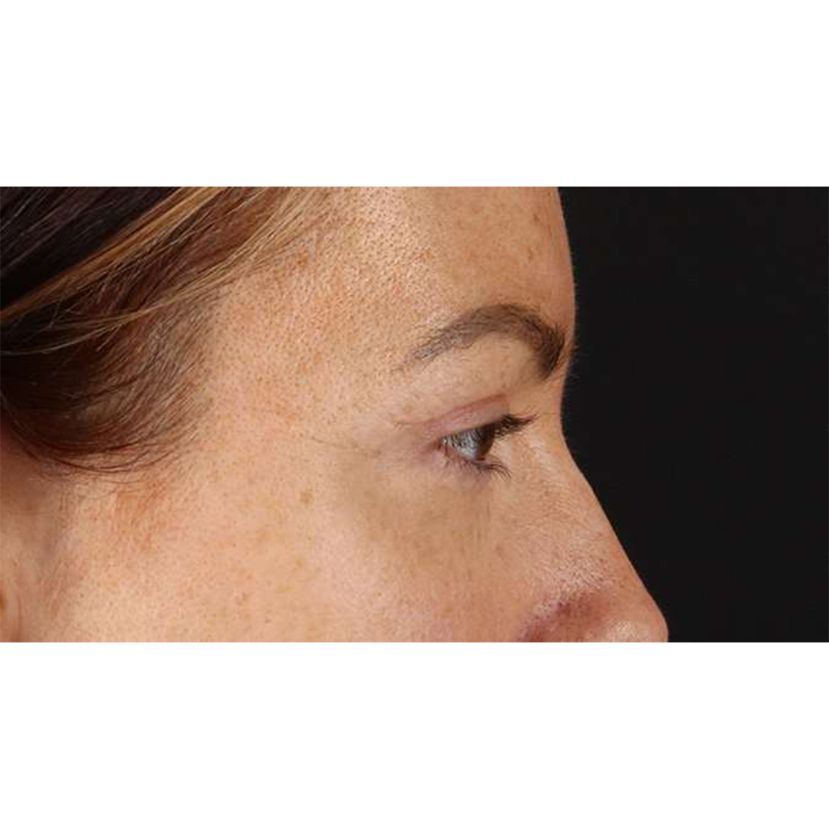 Eyelid Surgery Before & After Patient #1979