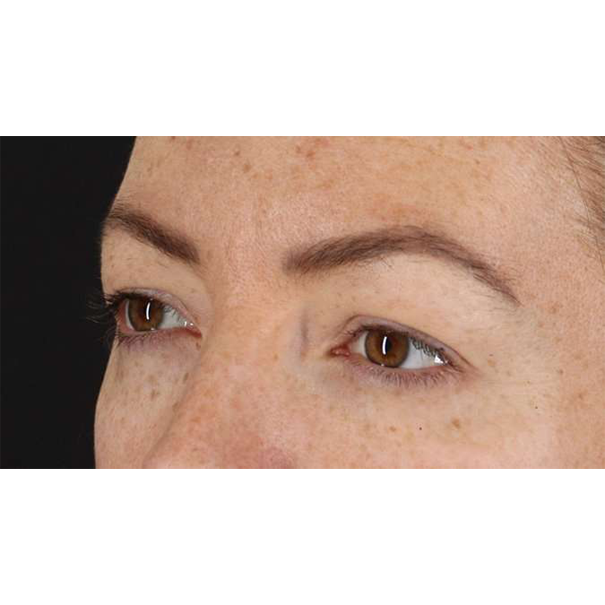Eyelid Surgery Before & After Patient #1979