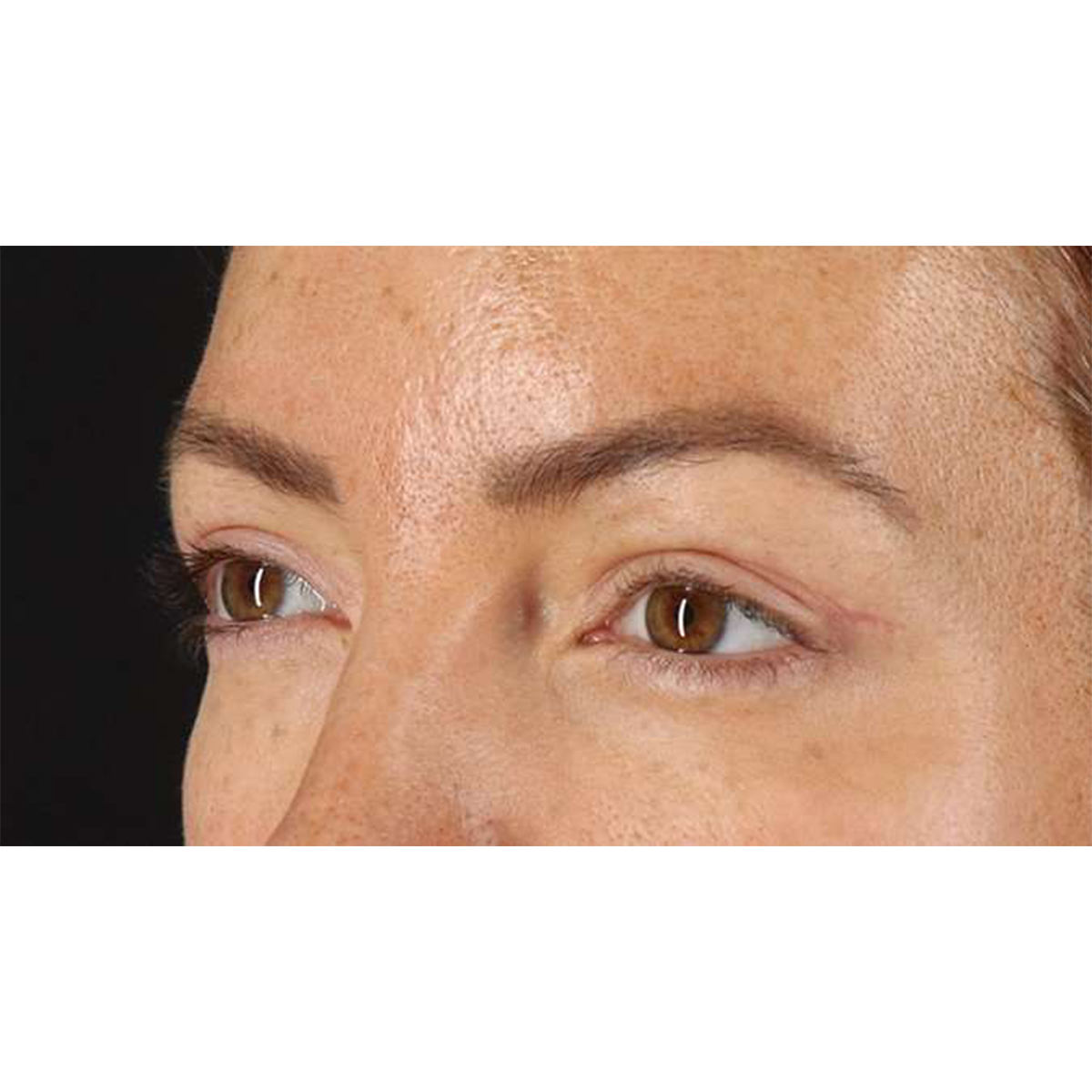Eyelid Surgery Before & After Patient #1979
