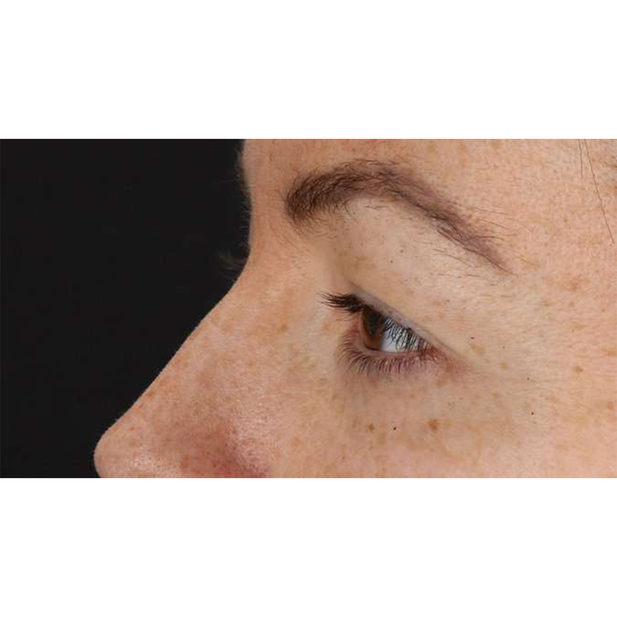 Eyelid Surgery Before & After Patient #1979