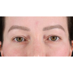 Eyelid Surgery Before & After Patient #1990