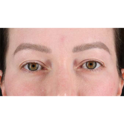 Eyelid Surgery Before & After Patient #1990