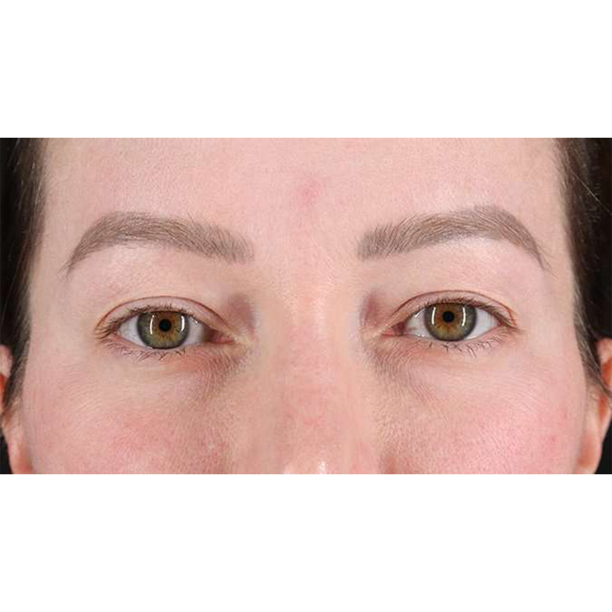 Eyelid Surgery Before & After Patient #1990