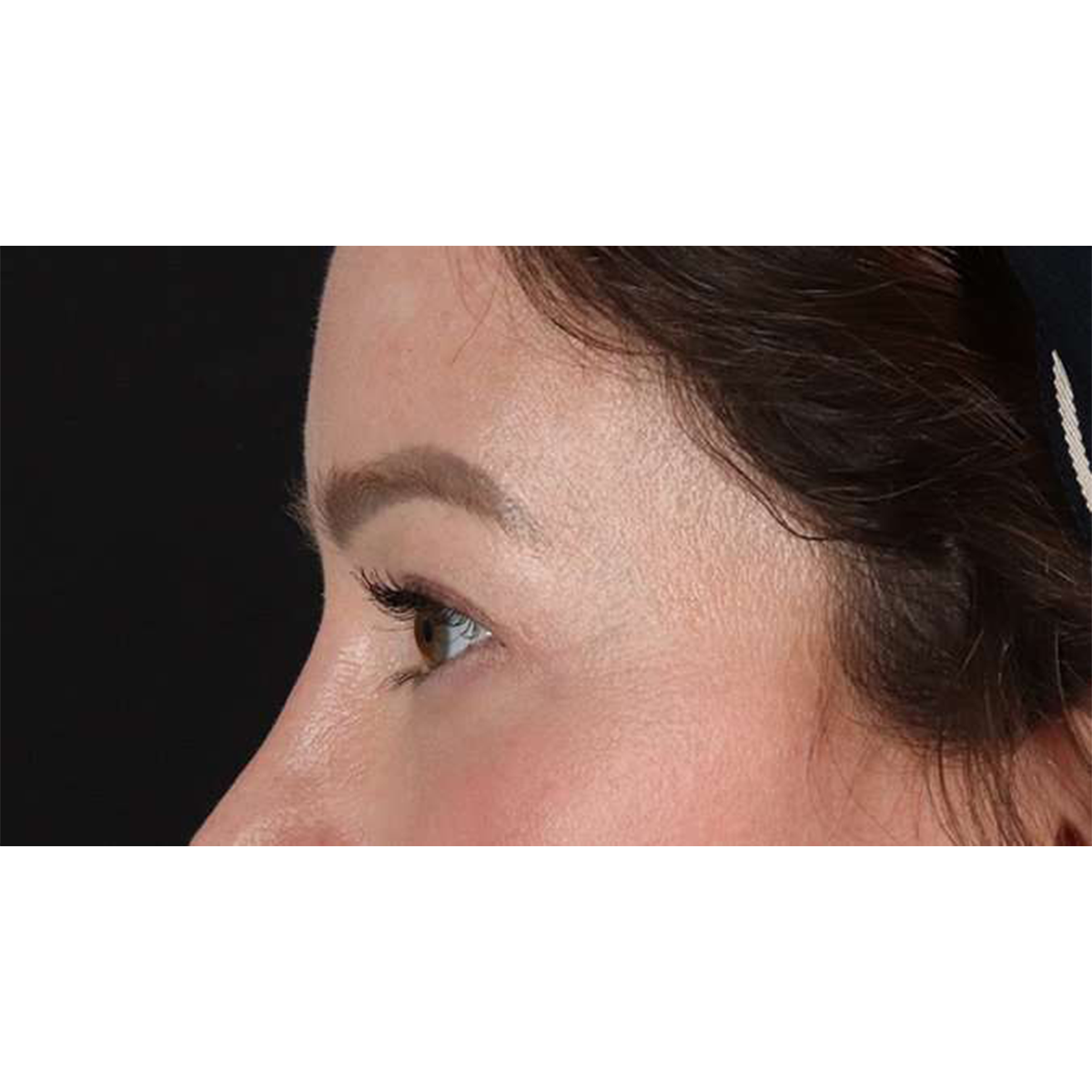 Eyelid Surgery Before & After Patient #1990