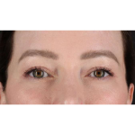 Eyelid Surgery Before & After Patient #1990