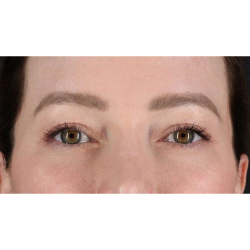 Eyelid Surgery Before & After Patient #1990