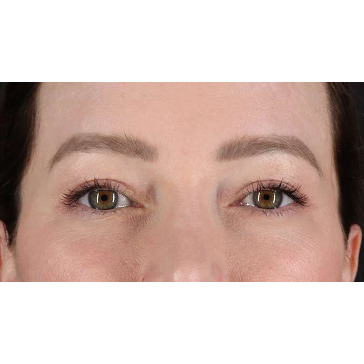 Eyelid Surgery Before & After Patient #1990