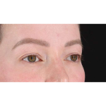 Eyelid Surgery Before & After Patient #1990