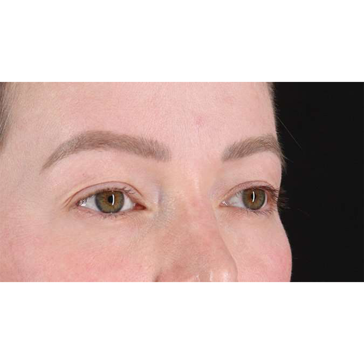 Eyelid Surgery Before & After Patient #1990
