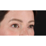 Eyelid Surgery Before & After Patient #1990
