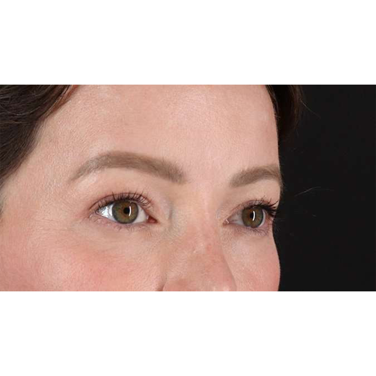Eyelid Surgery Before & After Patient #1990