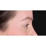 Eyelid Surgery Before & After Patient #1990