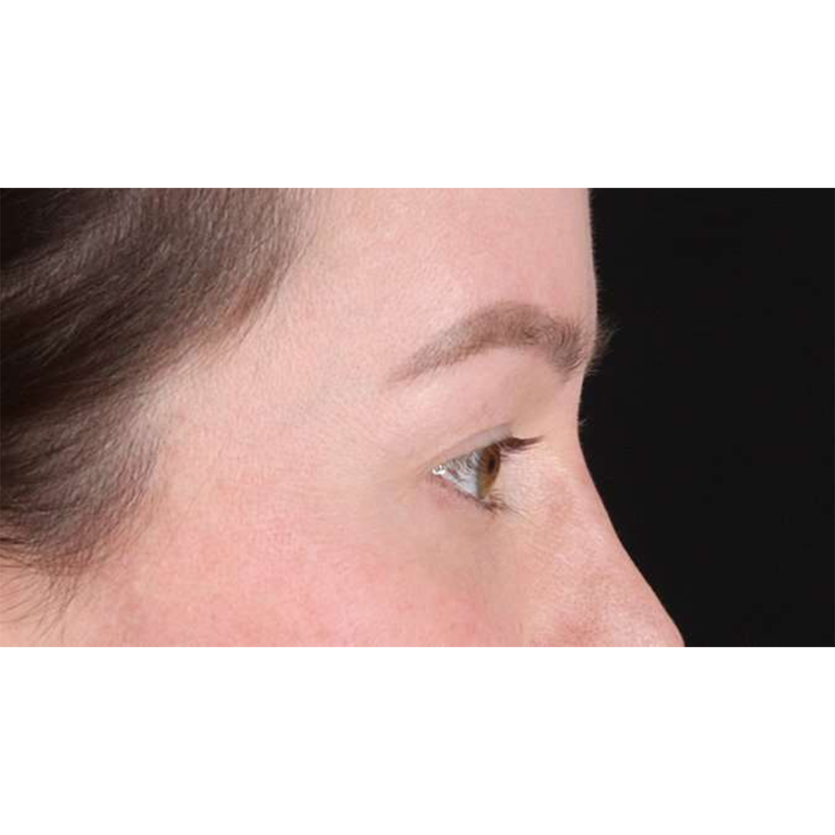 Eyelid Surgery Before & After Patient #1990
