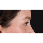 Eyelid Surgery Before & After Patient #1990