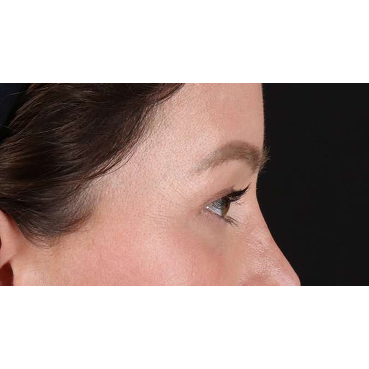 Eyelid Surgery Before & After Patient #1990