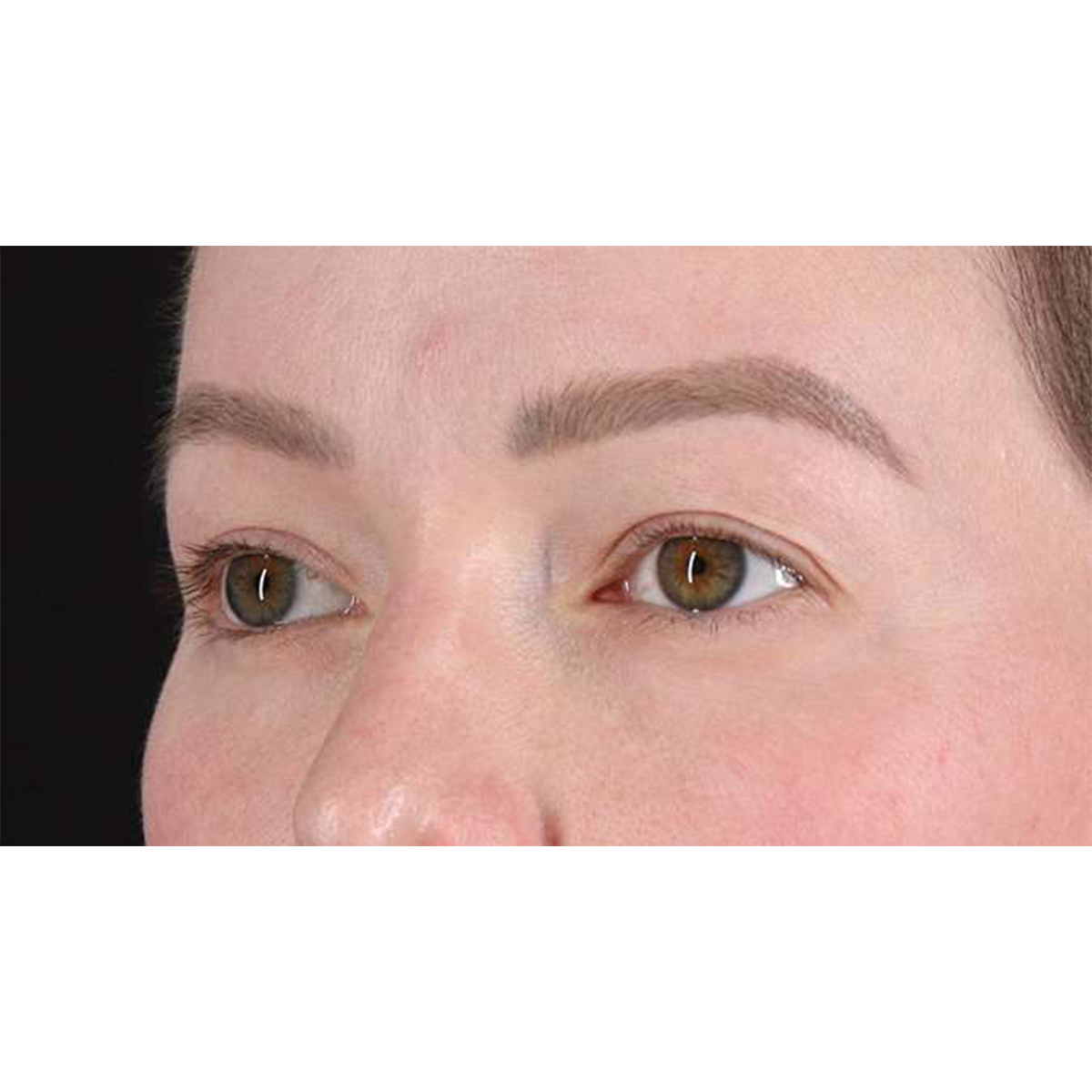 Eyelid Surgery Before & After Patient #1990