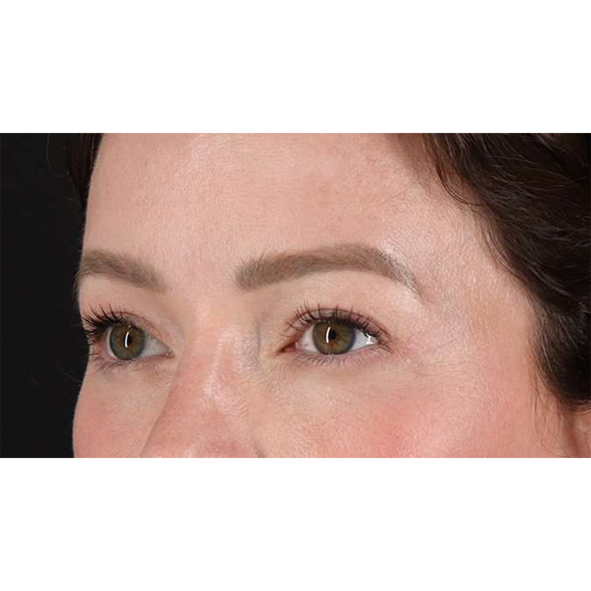 Eyelid Surgery Before & After Patient #1990