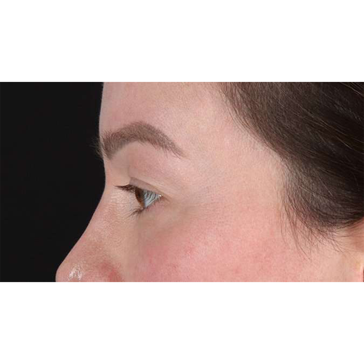 Eyelid Surgery Before & After Patient #1990