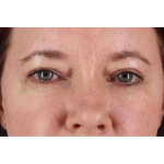 Brow Lift Before & After Patient #1566