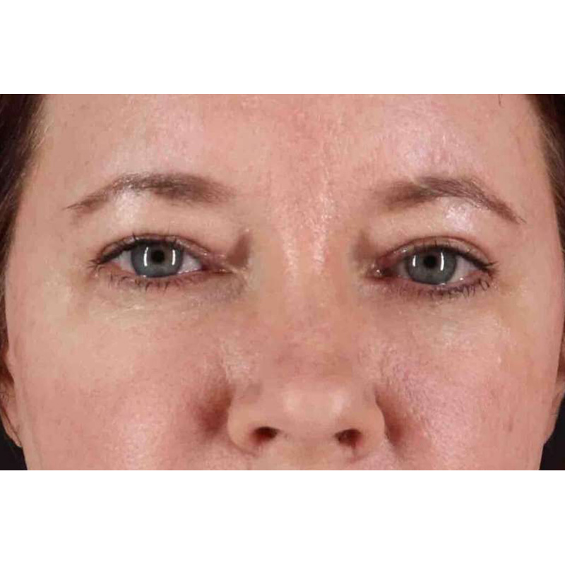 Brow Lift Before & After Patient #1566