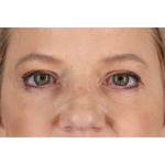 Brow Lift Before & After Patient #1577