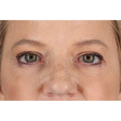 Brow Lift Before & After Patient #1577