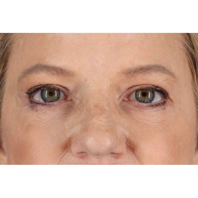 Brow Lift Before & After Patient #1577