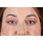Brow Lift Before & After Patient #1588