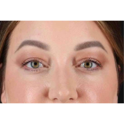 Brow Lift Before & After Patient #1588