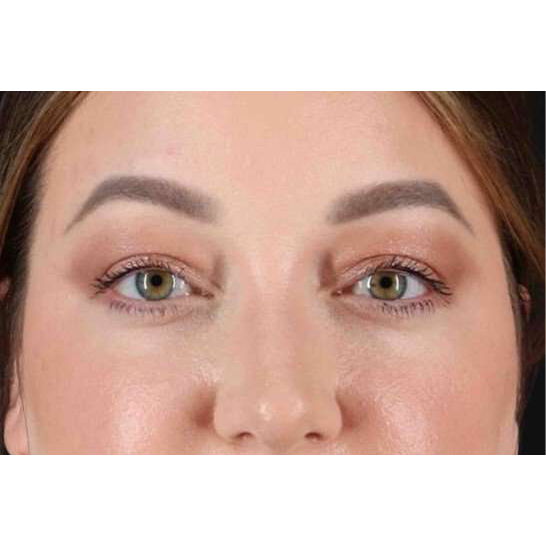 Brow Lift Before & After Patient #1588