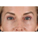 Laser Before & After Patient #2070