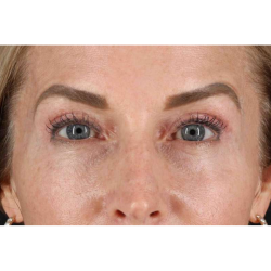 Laser Before & After Patient #2070