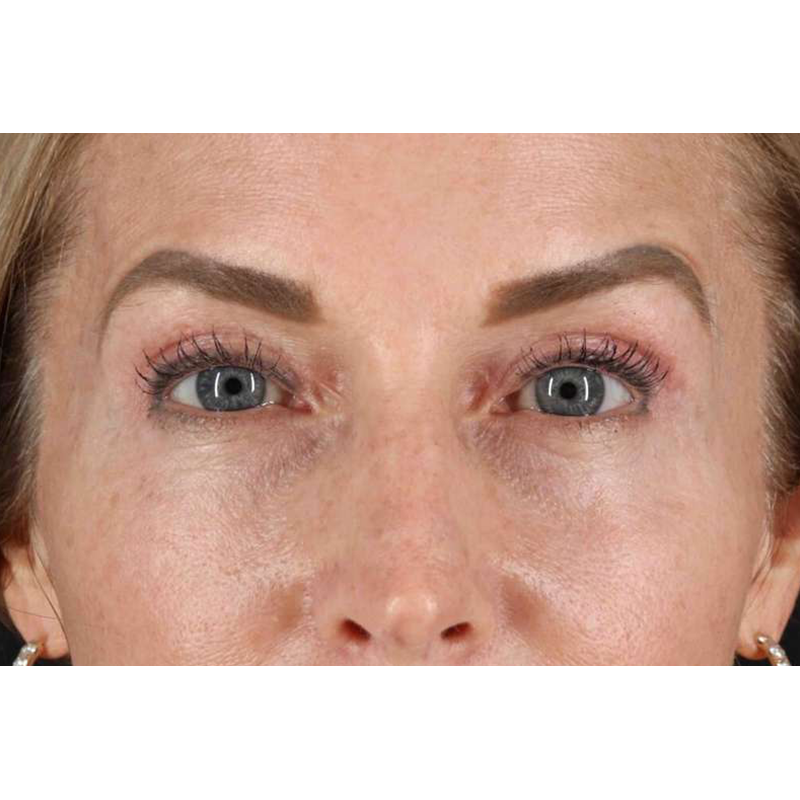 Laser Before & After Patient #2070