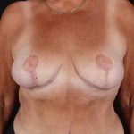 Breast Reduction with Lift Before & After Patient #1016