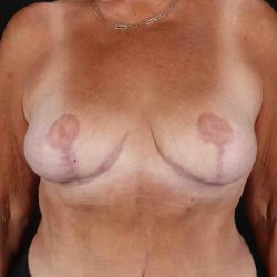 Breast Reduction with Lift Before & After Patient #1016