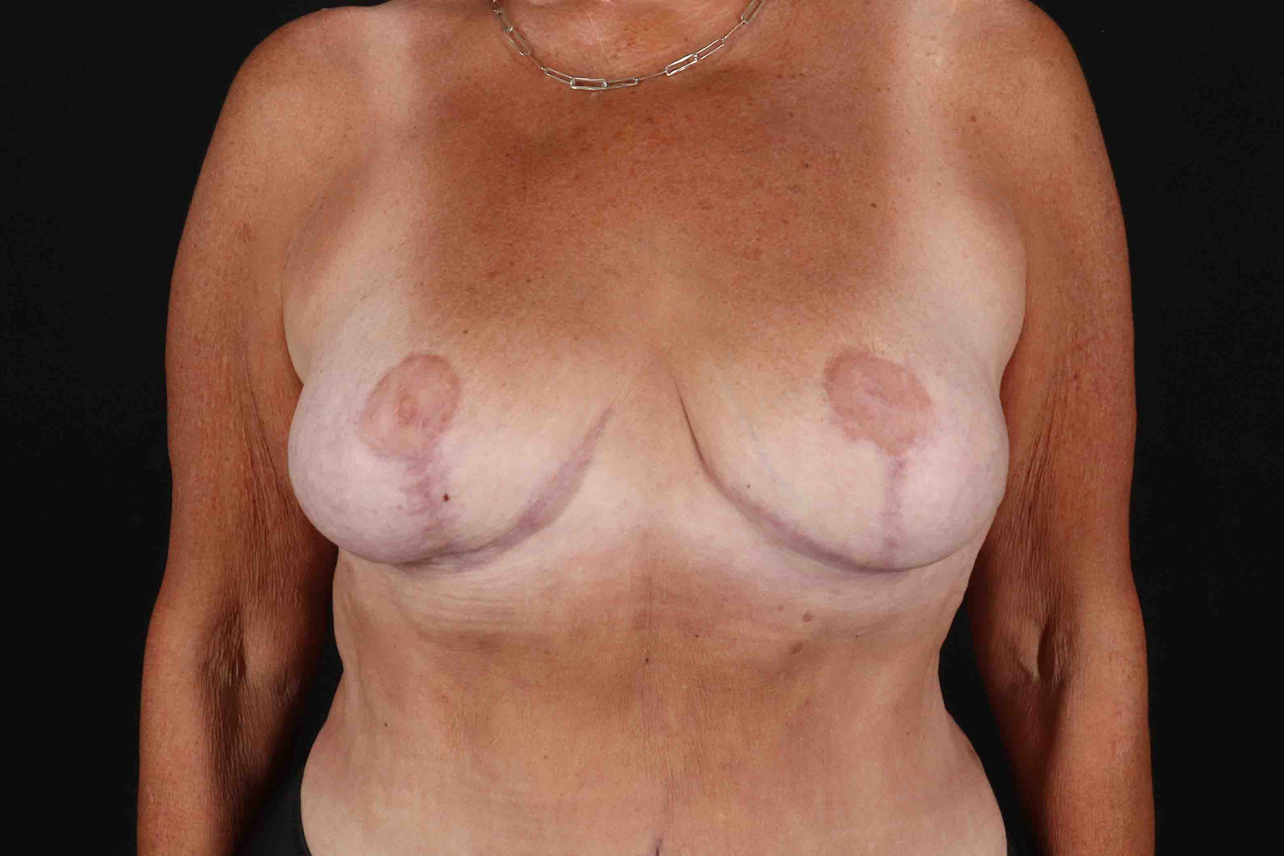 Breast Reduction with Lift Before & After Patient #1016